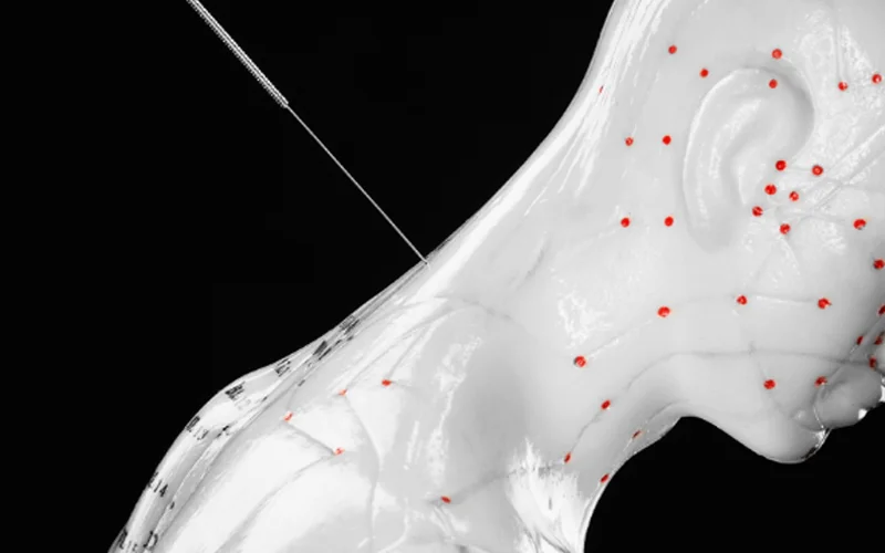 During acupuncture, fine needles are placed at targeted points on the body. Researchers are now uncovering how this localized stimulation can ripple through connective tissue, the nervous system, and the brain to ease pain.