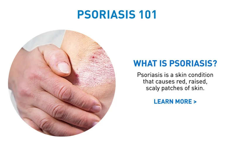 What is Psoriasis?