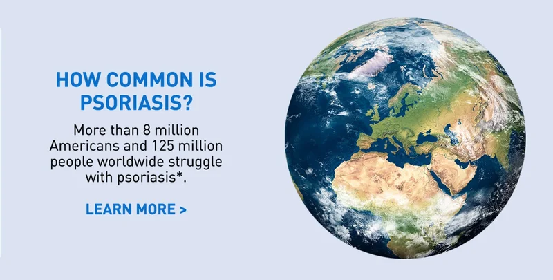How Common is Psoriasis?