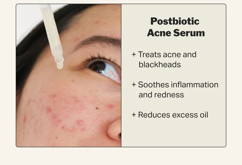 Postbiotic  Acne Serum + Treats acne and      blackheads  + Soothes inflammation      and redness  + Reduces excess oil