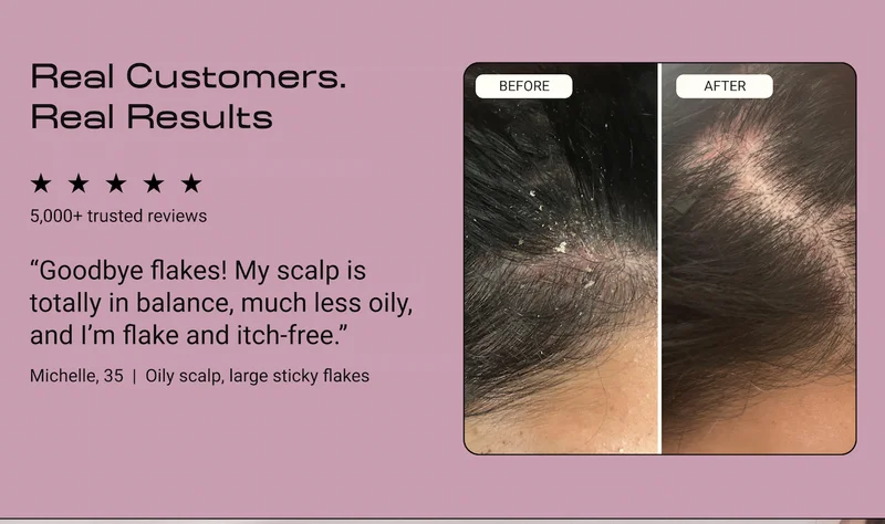 Before-and-after scalp photos showing visible reduction in flakes after using the Flake-Free Duo. Five-star rating with "5,000+ trusted reviews." Customer quote: "Goodbye flakes. My scalp is totally in balance, much less oily, and I'm flake and itch-free." Attributed to Michelle, 35, oily scalp with large sticky flakes.