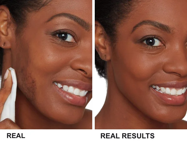BETTER SKIN IN 2 WEEKS*