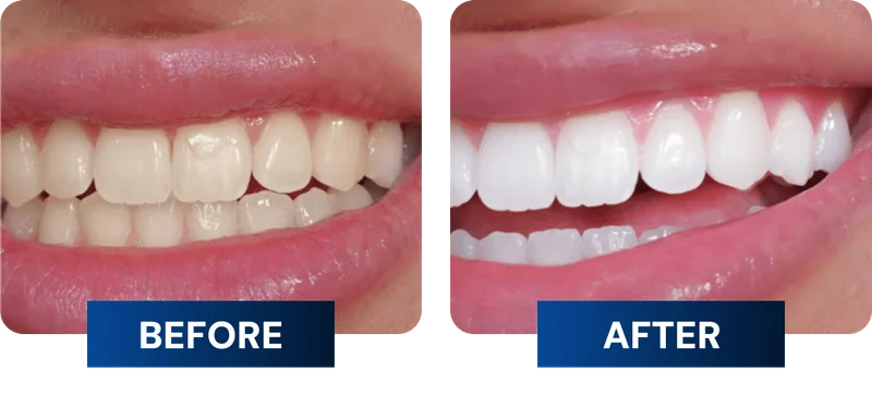 Before and After