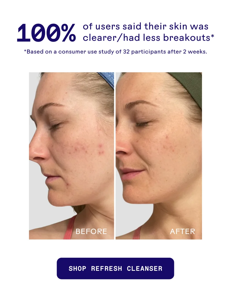 100% of users said their skin was clearer/had less breakouts. Shop Refresh now.