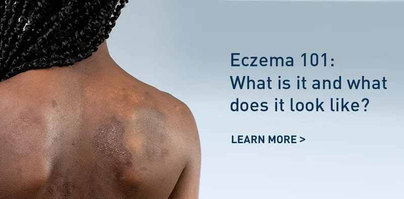 ECZEMA 101