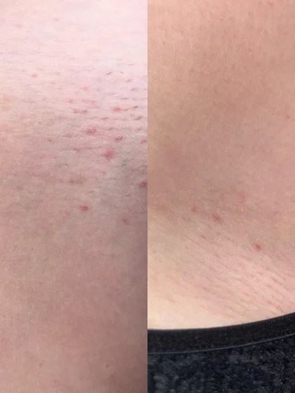 Lucia’s bikini line after 3 weeks