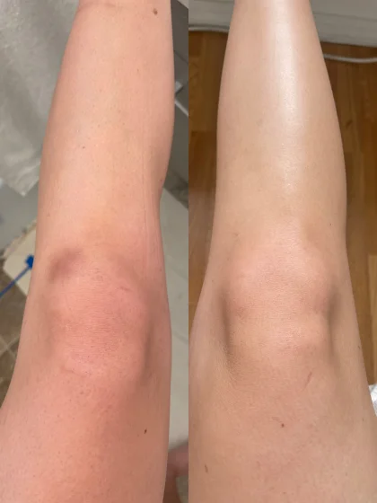 Halle’s knee after 4 weeks