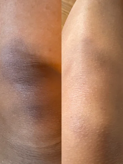 Zoe’s knee after 4 weeks