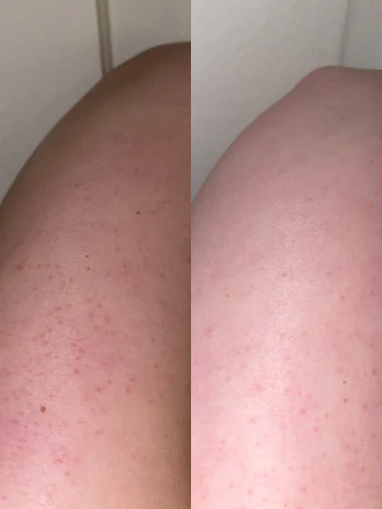Alexa’s arm after 8 days