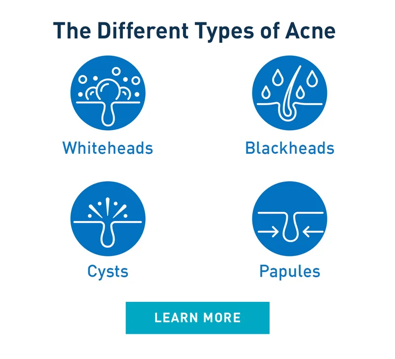 The Different Types of Acne