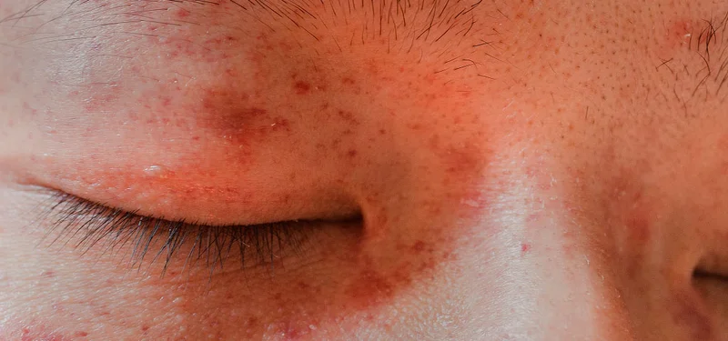 Treat acne, redness, and eczema