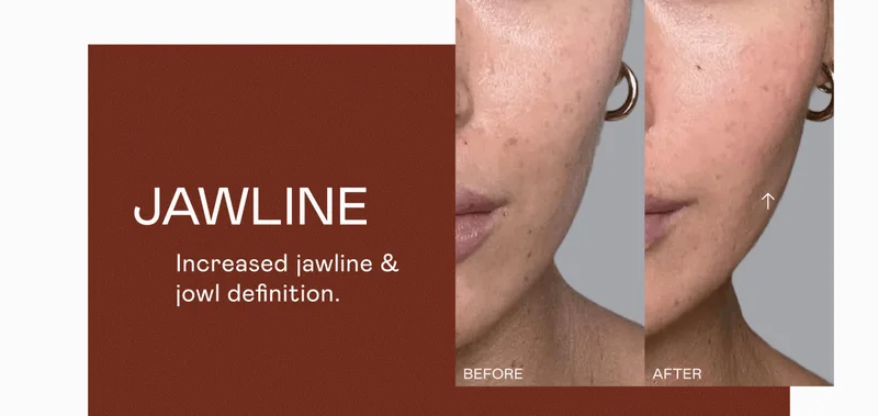 Jawline - Increased jawline & jowl definition.
