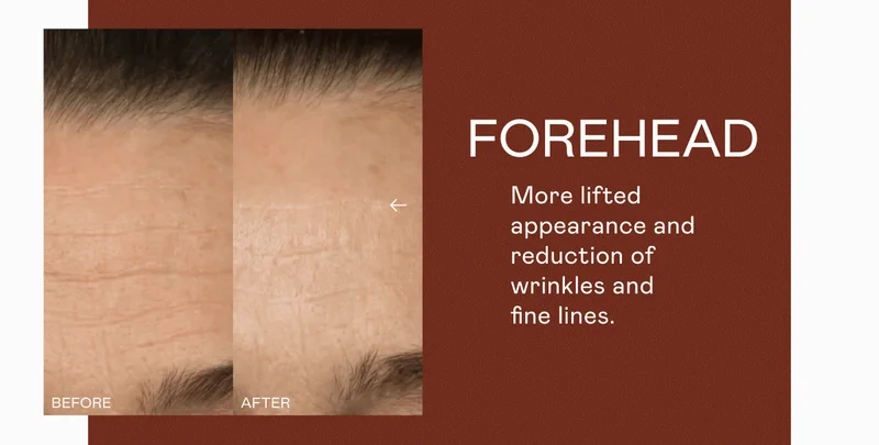Forehead - More lifted appearance and reduction of wrinkles and fine lines.