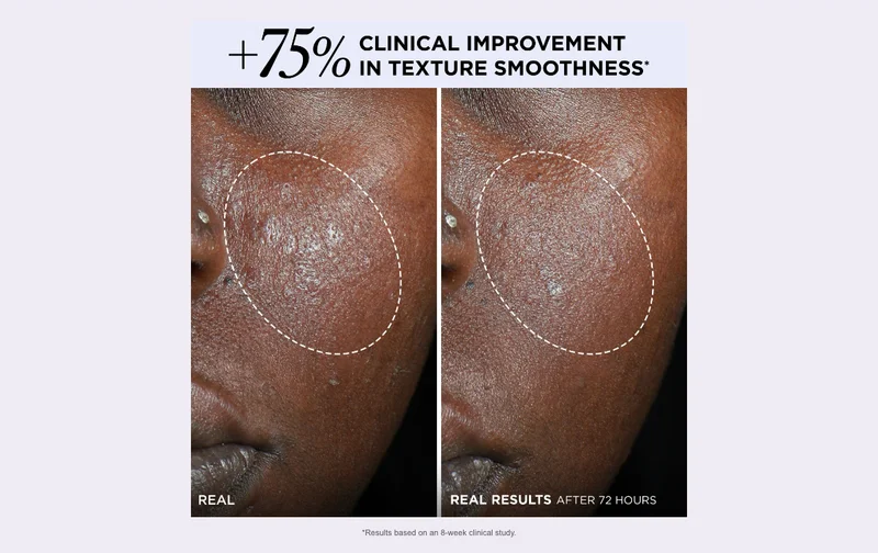 75% Clinical Improvement