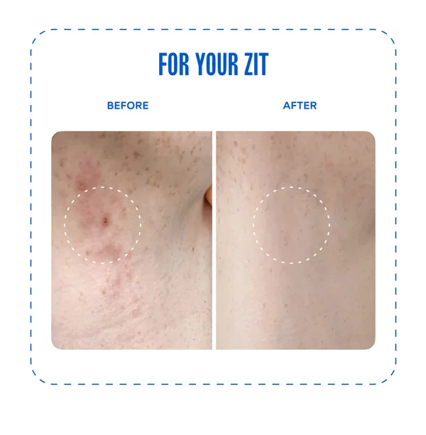 For your zit