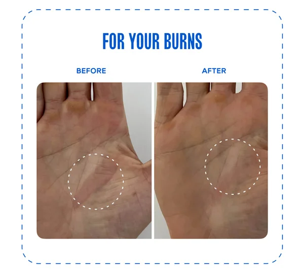 For your burns