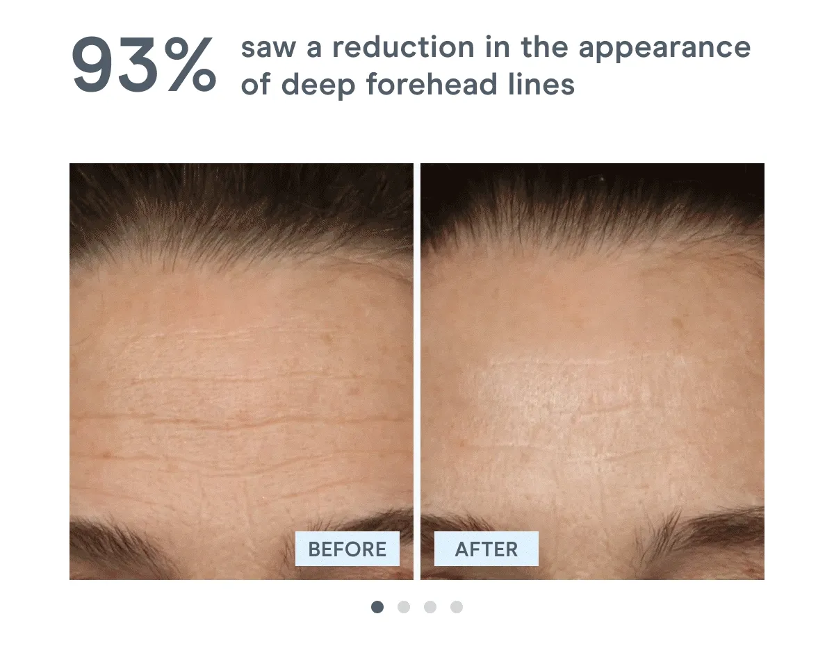93% saw a reduction in the appearance of deep forehead lines. | 95% saw an improvement in the sagging skin around the neck. | 92% saw an increase in skin tone. | 80% saw a lifted brow & awakened eye.