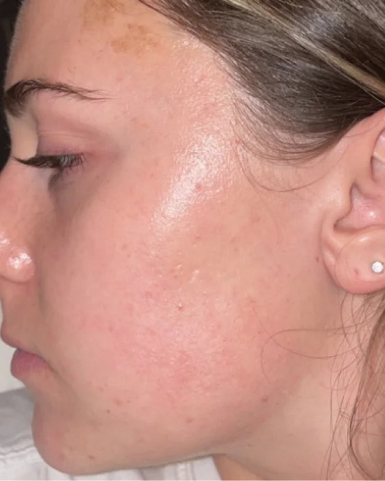 After image of patient Sara