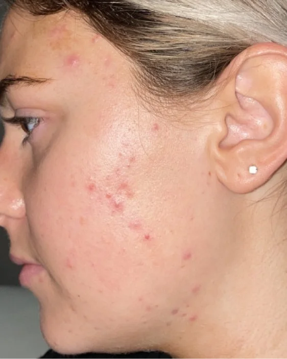 Before image of patient Sara