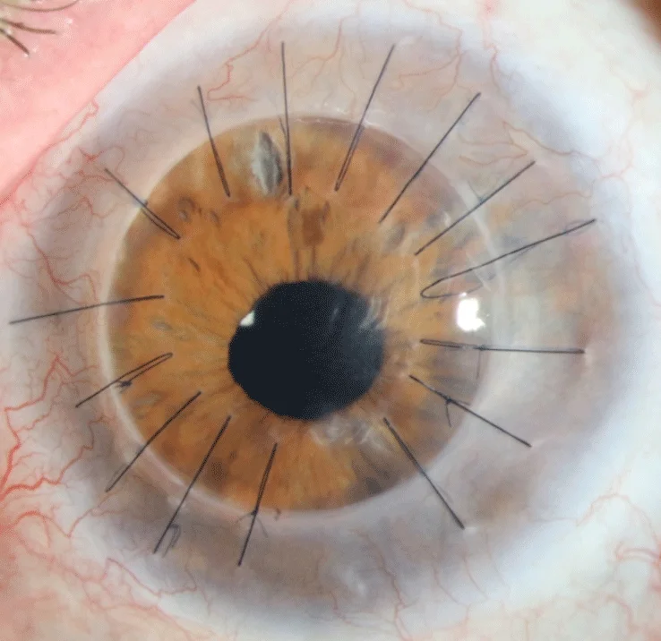 In experimental trials, doctors can now restore vision by replacing limbal epithelial cells, a category of stem cells vital to repairing the cornea. This eye is 18 months post operation.