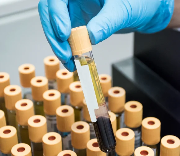 The American Heart Association and other cardiac groups now recommend that everyone should be tested once for a type of cholesterol called lipoprotein(a) or Lp(a) that increases the risk for heart disease.