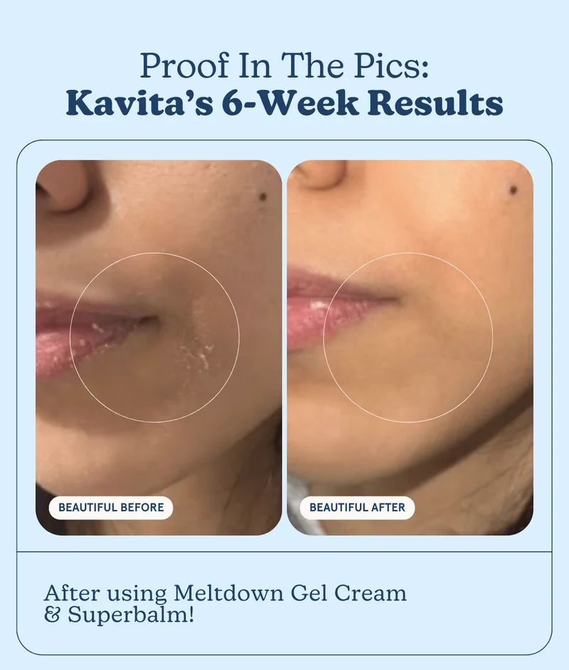 Proof In The Pics: Kavita’s 6-Week Results: After using Meltdown Gel Cream & Superbalm!