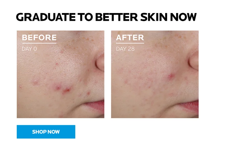 Graduate to better skin now