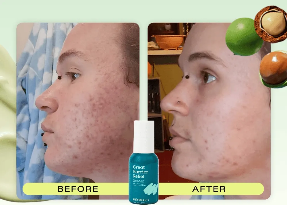 Before and After