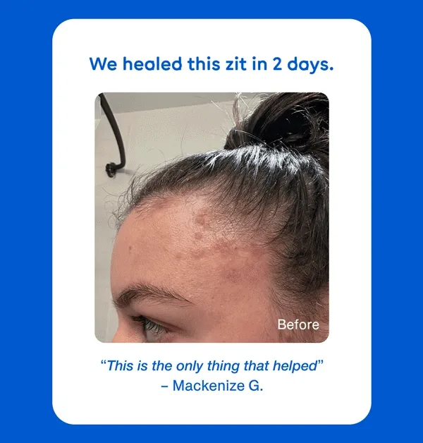 We healed this zit in 2 days