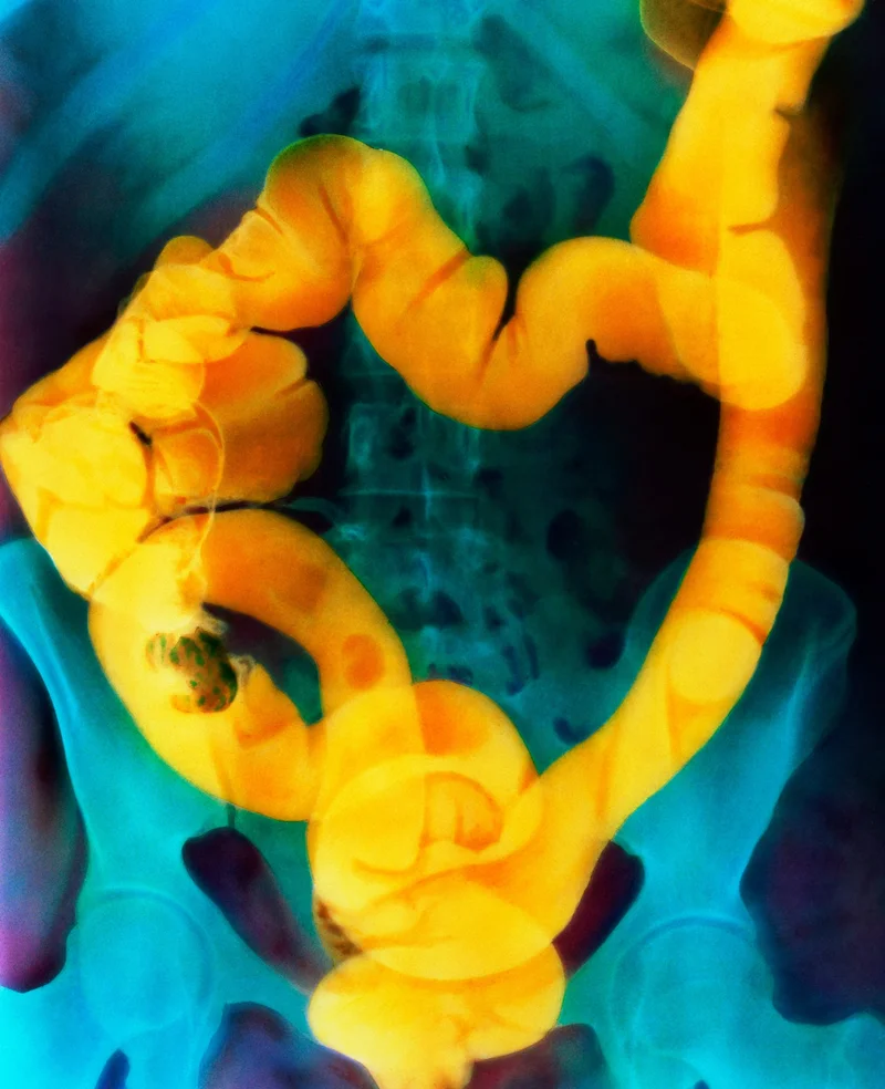 This colorized abdominal X-ray shows cancer of the ascending colon; the tumor appears as the oval shadow over the right pelvic bone (left on image).