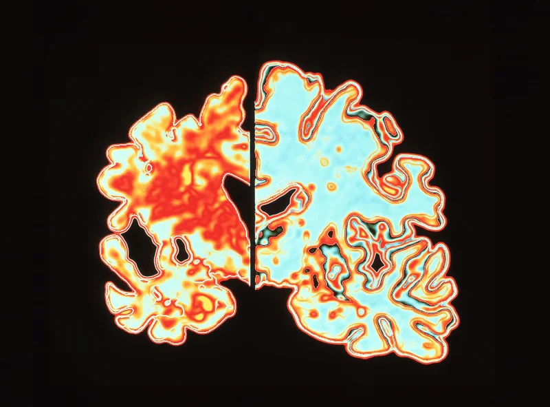 This computer graphic shows a slice through the brain of an Alzheimer patient (at left) compared with a normal brain (at right). The Alzheimer's disease brain is considerably shrunken. Alzheimer's disease is a common cause of dementia.
