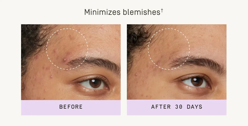 Minimizes blemishes+