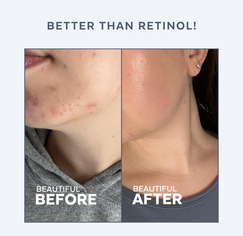 BETTER THAN RETINOL