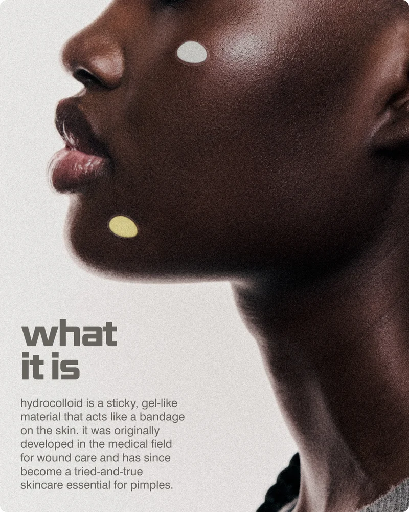what it is: Hydrocolloid is a sticky, gel-like material that acts like a bandage on the skin. It was originally developed in the medical field for wound care and has since become a tried-and-true skincare essential for pimples.