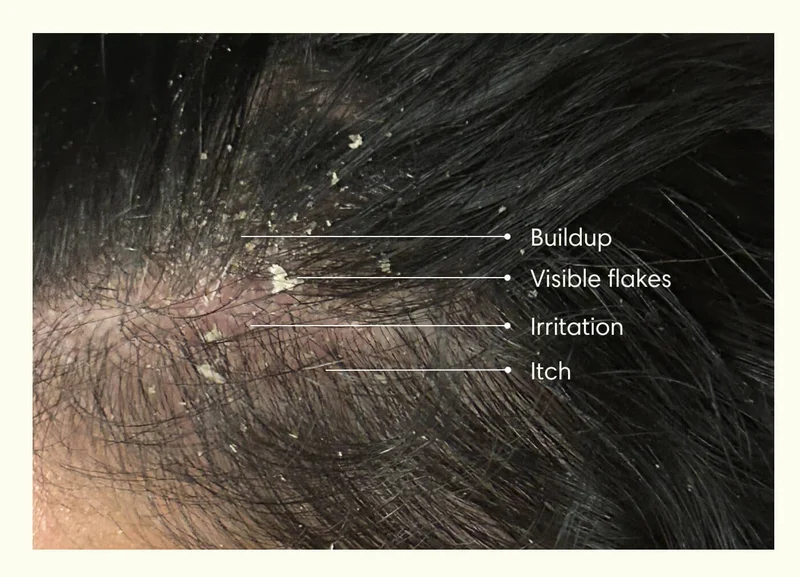- Buildup  - Visible flakes  - Irritation  - Itch