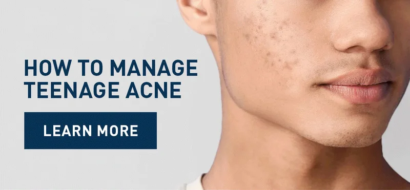 HOW TO MANAGE TEENAGE ACNE