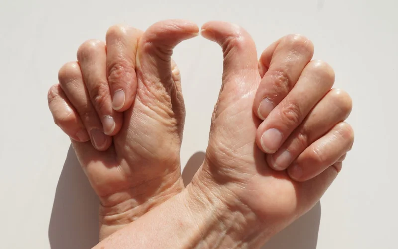 Recent studies suggest that people with hypermobile joints have a heightened risk for developing chronic conditions including long COVID, POTS, mast cell activation syndrome (MCAS), and myalgic encephalomyelitis chronic fatigue syndrome.