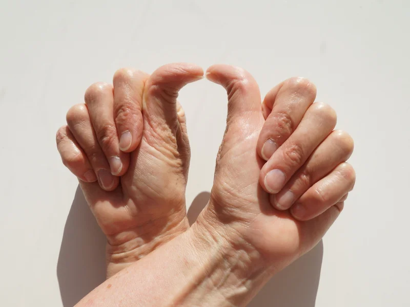 Two hands are shown with their thumbs pointing towards each other at an extreme bend.