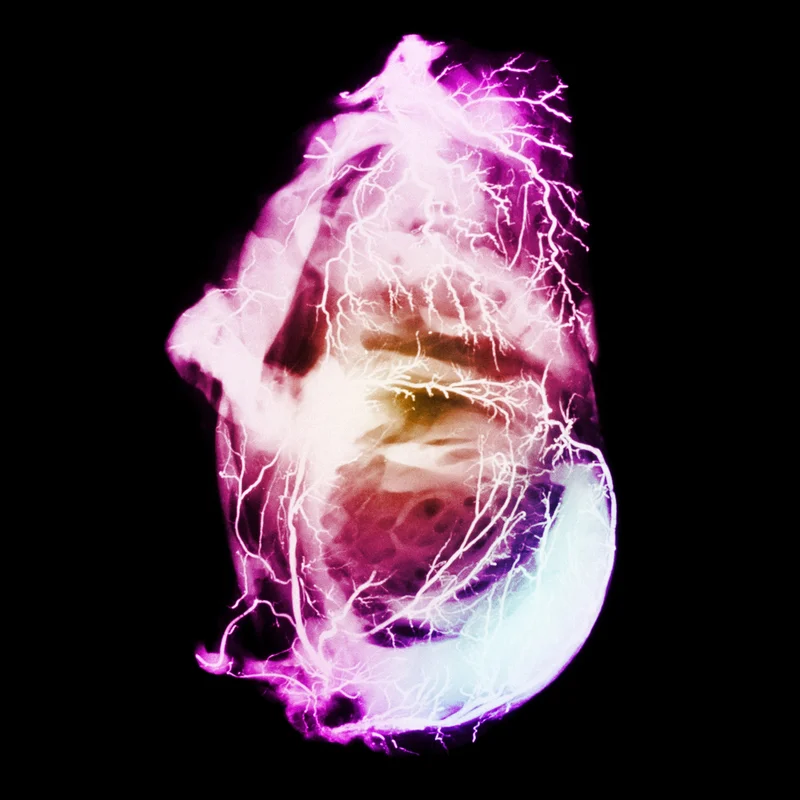An angiogram shows the death of part of the heart muscle after a heart attack.