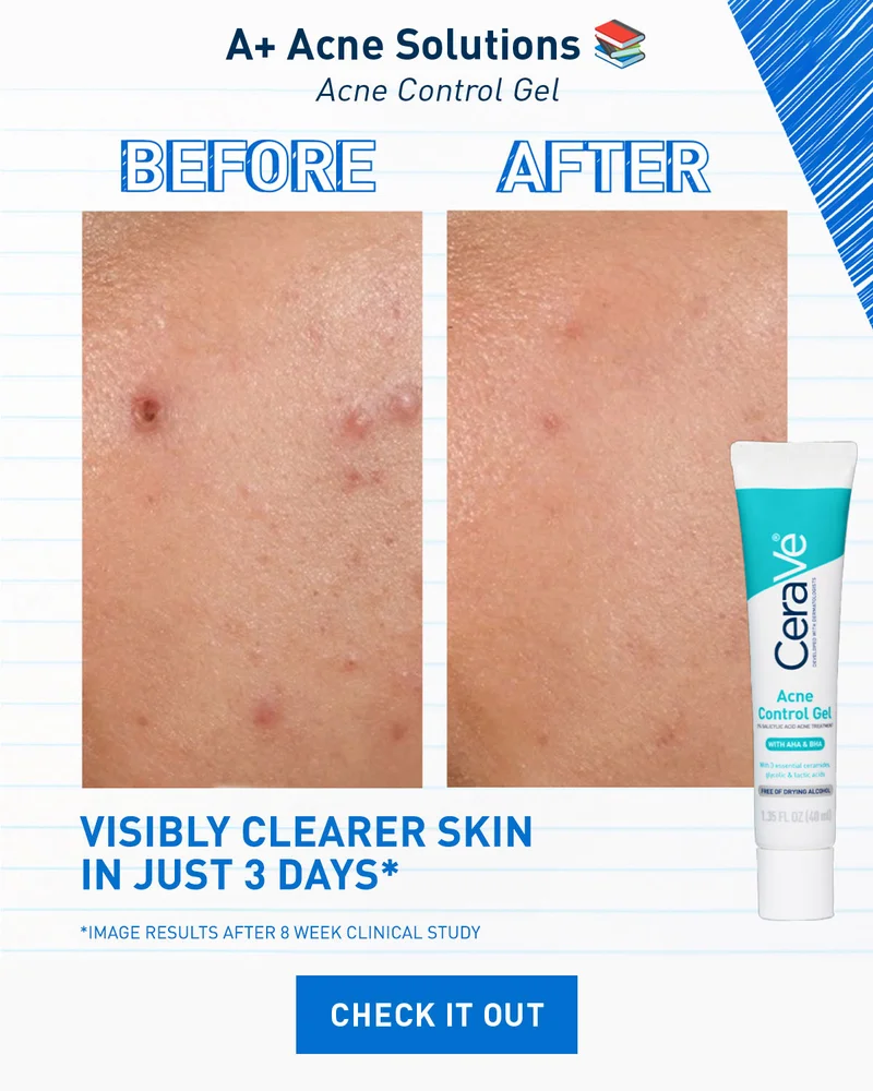 A+ Acne Solutions