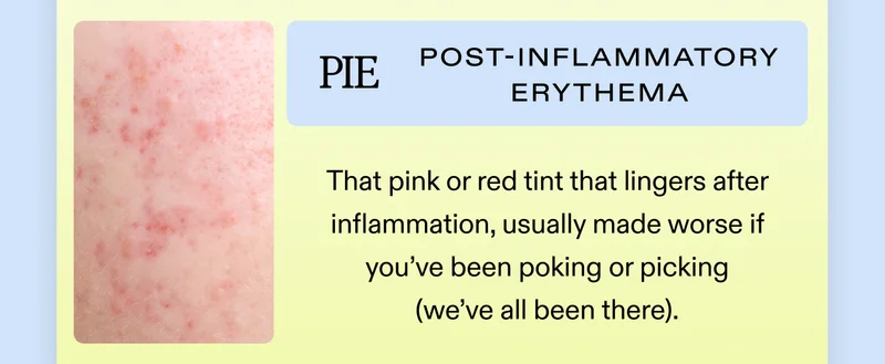 PIE (Post-inflammatory Erythema) That pink or red tint that lingers after inflammation, usually made worse if you’ve been poking or picking (we’ve all been there).