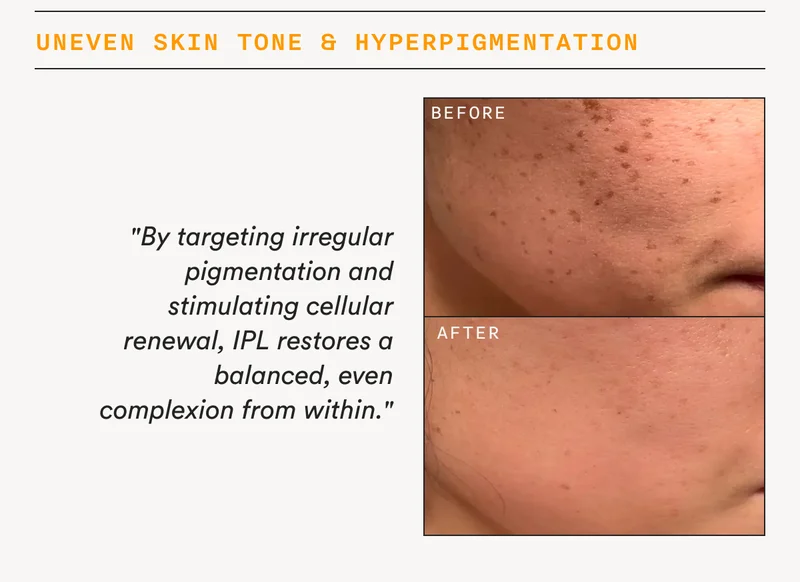 Uneven Skin Tone & Hyperpigmentation