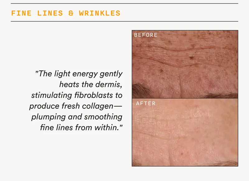 Fine Lines & Wrinkles