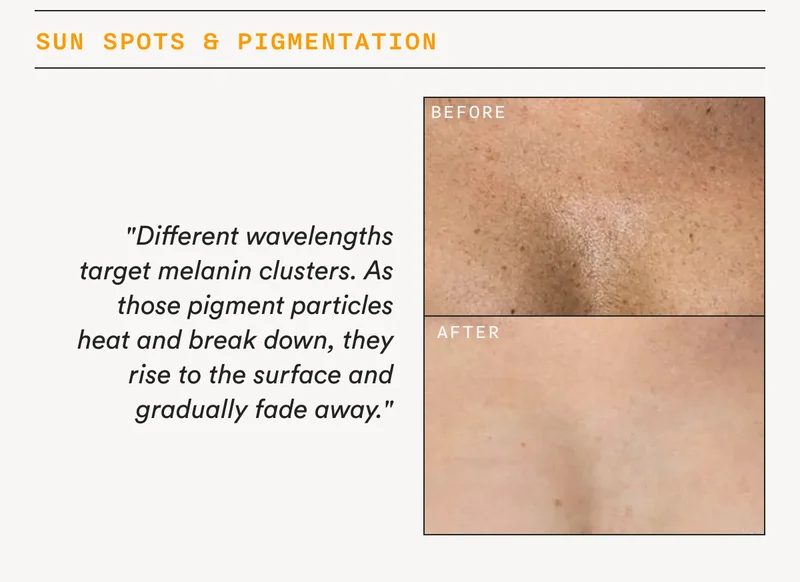Sun Spots & Pigmentation
