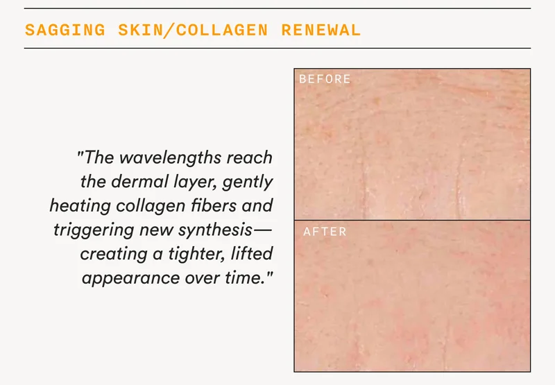 Sagging Skin/Collagen Renewal