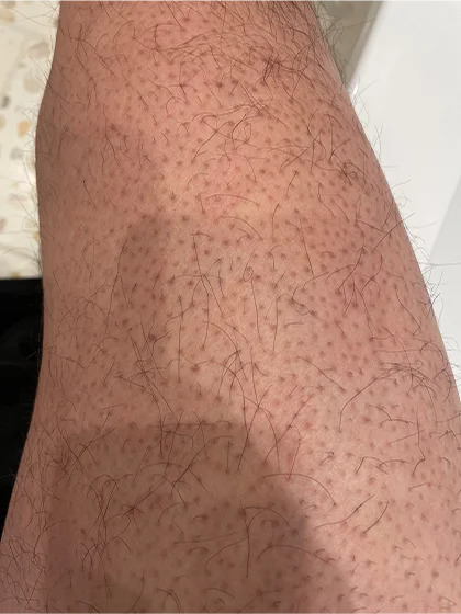 Upper Leg