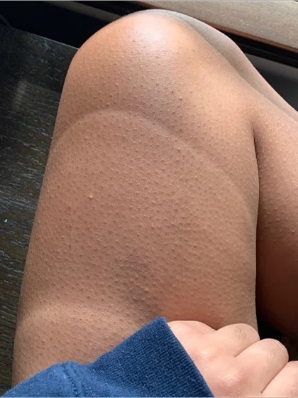 Upper Leg