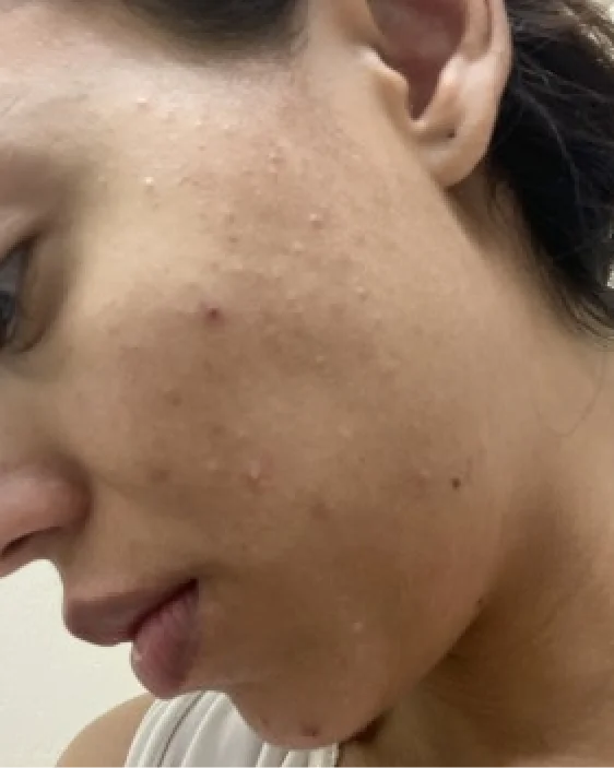 Before image of Laura's skin