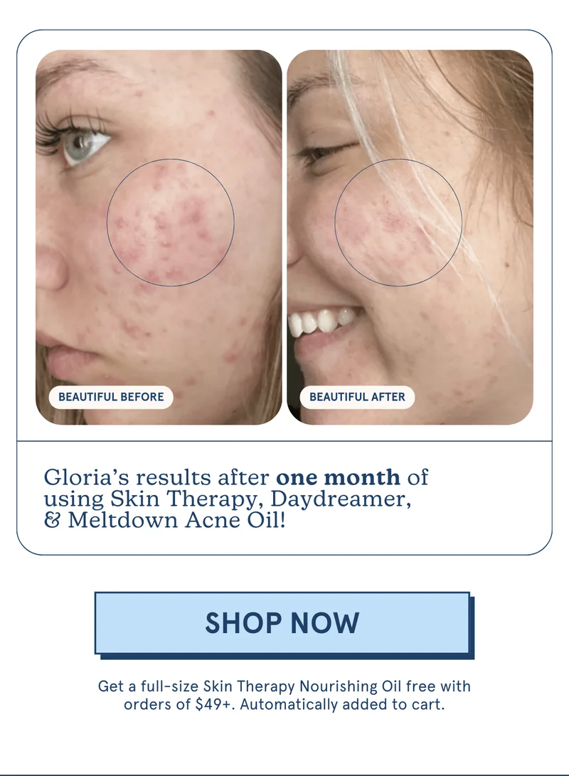 Gloria’s results after one month of using Skin Therapy, Daydreamer, & Meltdown Acne Oil! [SHOP NOW] Get a full-size Skin Therapy Nourishing Oil free with orders of $49+. Automatically added to cart.