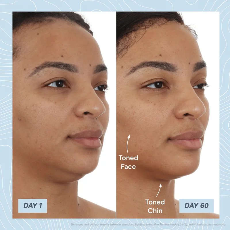 Side by Side comparison of before and after microcurrent treatment